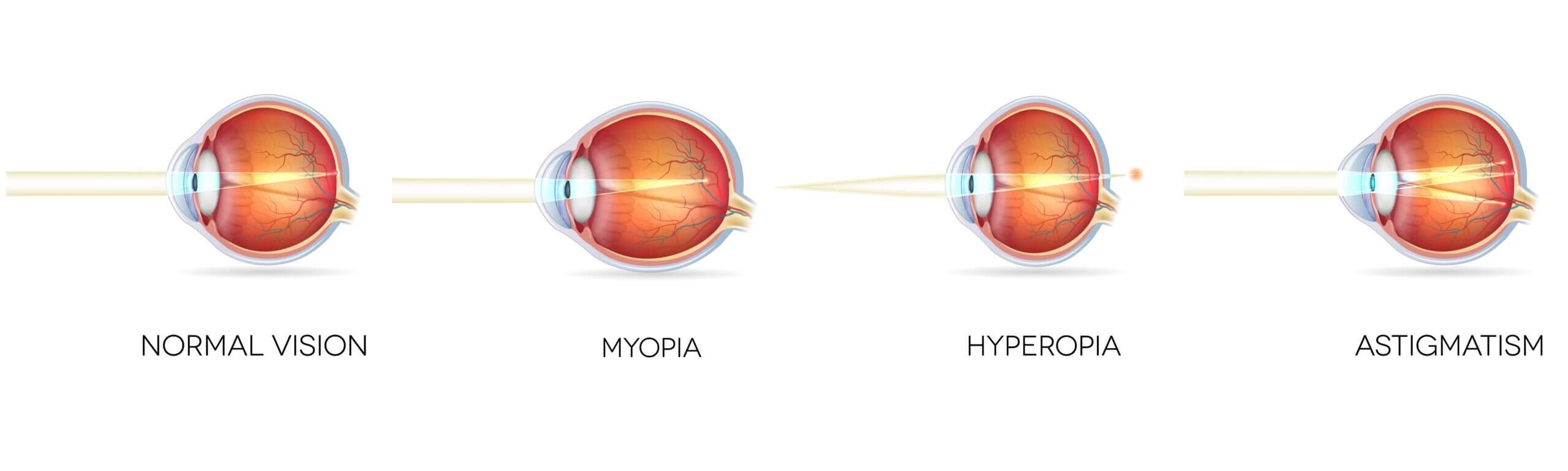 Eyesight disorders. Normal eye, Astigmatism, hyperopia and myopia.